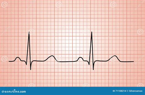 ELECTROCARDIOGRAM .
